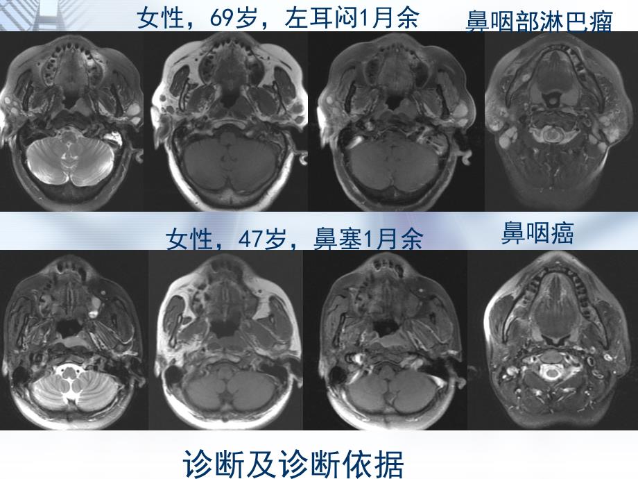 鼻咽部淋巴瘤课件_第1页