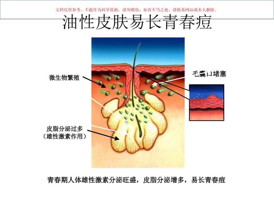 油性皮肤和痤疮课件_第1页