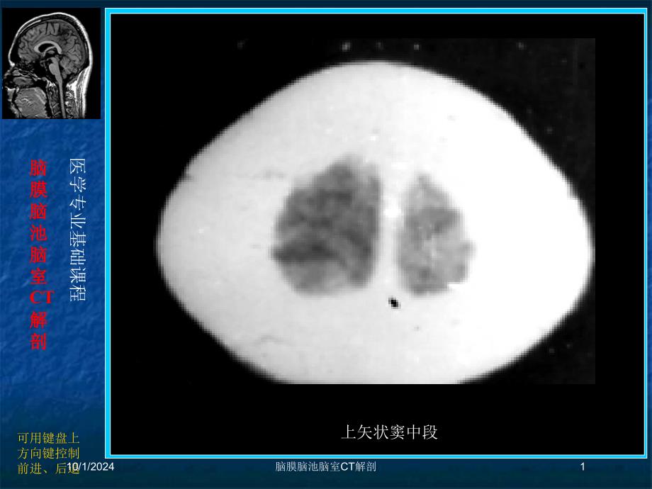 脑膜脑池脑室CT解剖培训课件_第1页