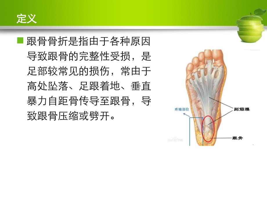 跟骨骨折护理查房实用课件_第1页