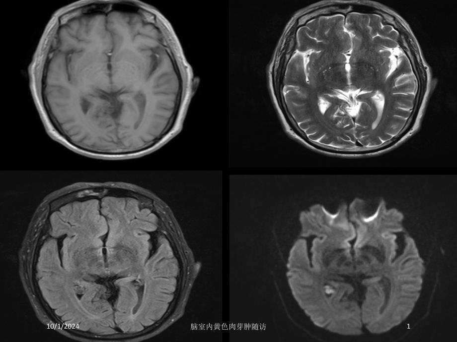 脑室内黄色肉芽肿随访培训课件_第1页