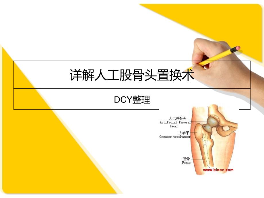 详解人工股骨头置换术课件_第1页