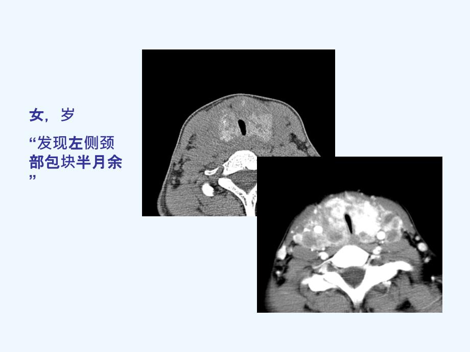 读书报告—小甲状腺癌课件_第1页