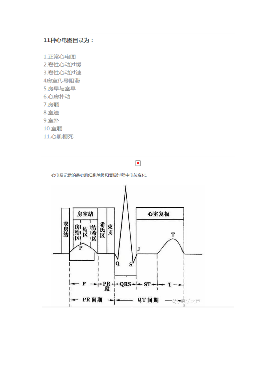 11种常见心电图_第1页