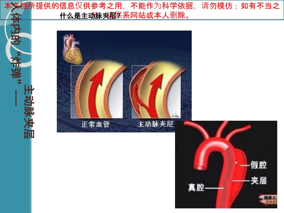 主动脉夹层的诊断治疗培训课件_第1页