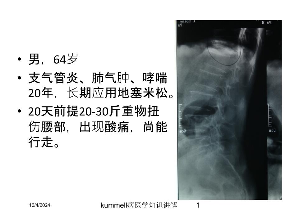 kummell病医学知识讲解课件_第1页