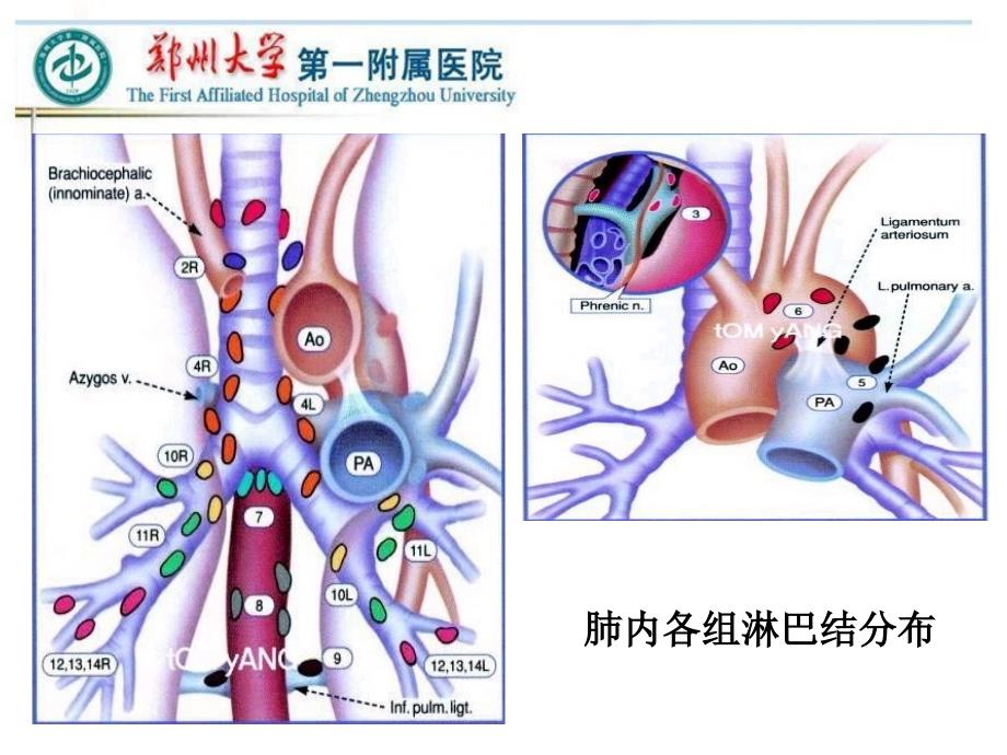 VATS左侧肺癌根治术中的淋巴结清扫主题讲座课件_第1页