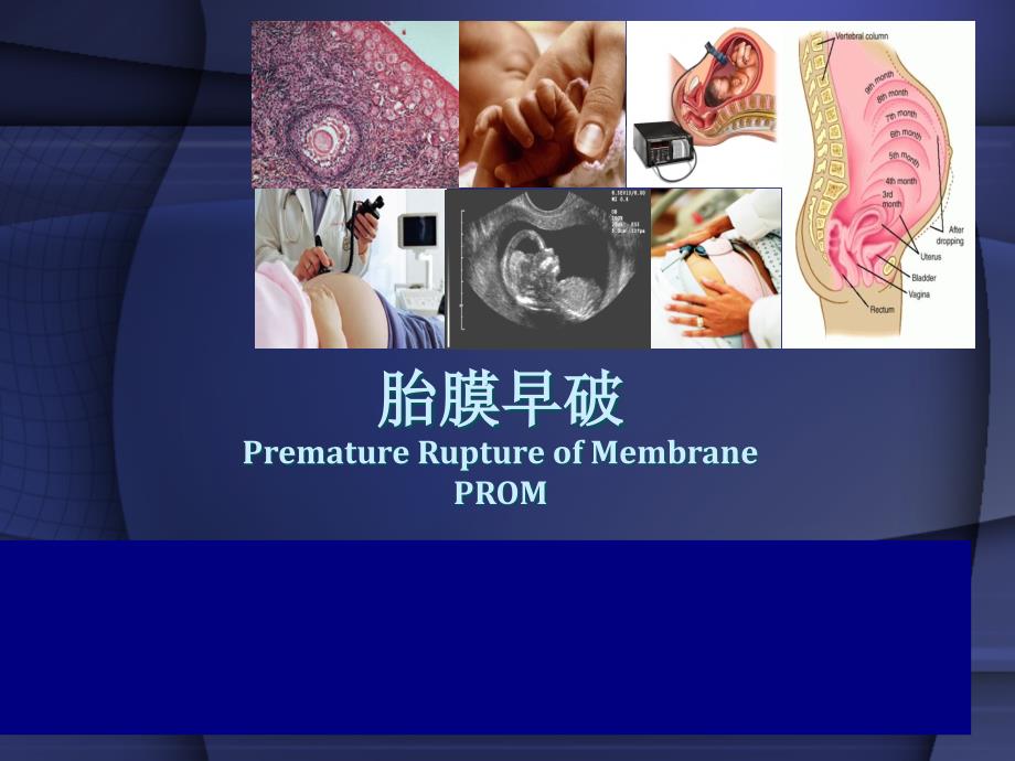 产科――胎膜早破产科学课件_第1页