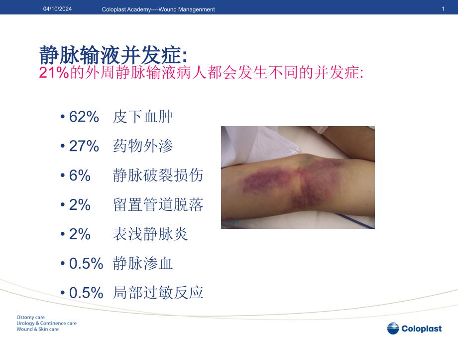 PPT医学课件静脉炎的预防和处理讲义_第1页