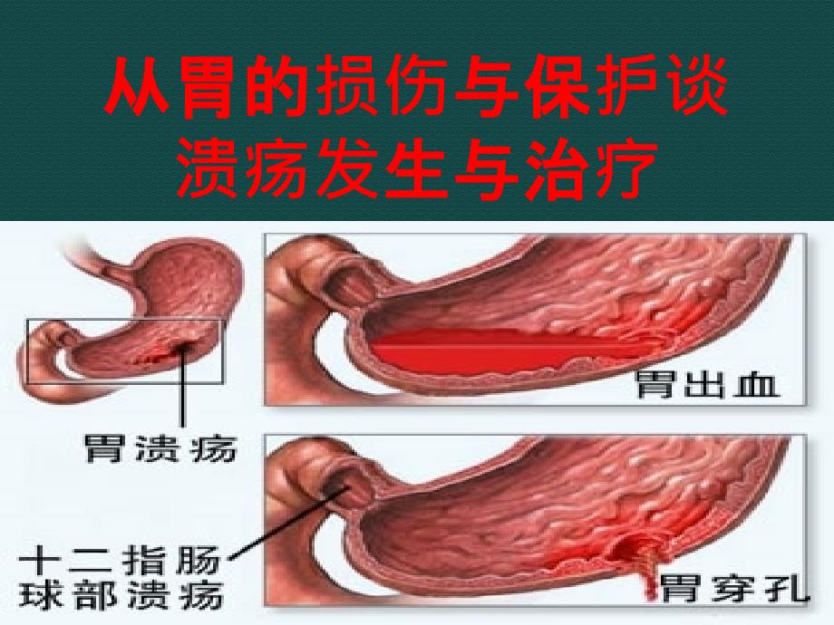 从胃的损伤与保护谈溃疡_第1页