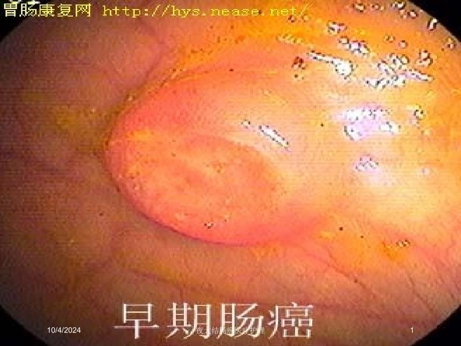 夜大结肠癌医疗护理课件_第1页