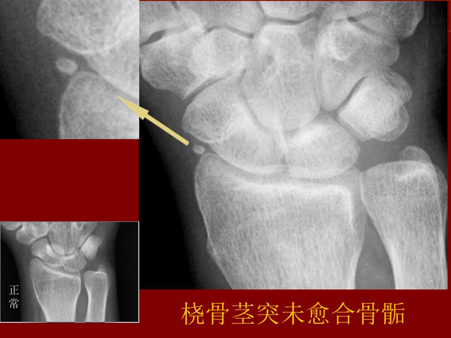 易误认为骨折的骨骺培训课件_第1页