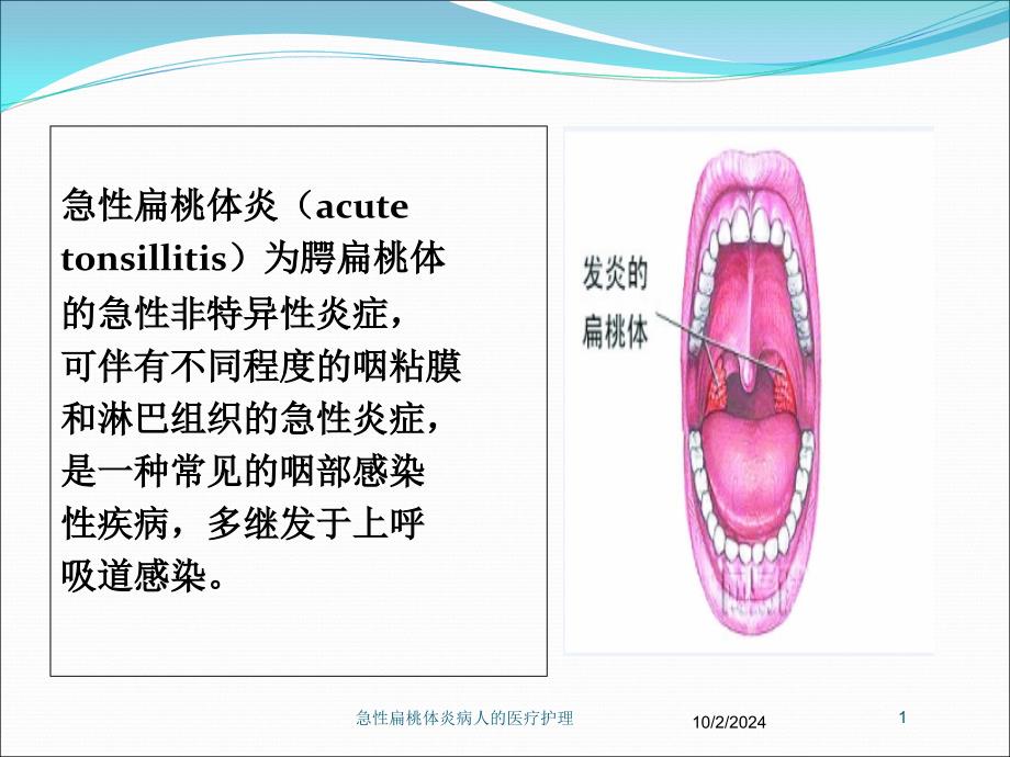 急性扁桃体炎病人的医疗护理培训课件_第1页