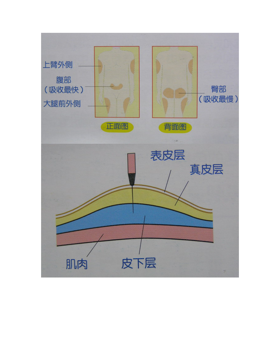 胰島素注射方法示意圖