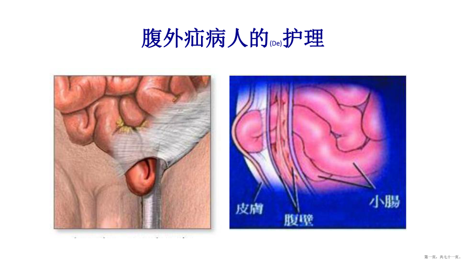 腹外疝病人的護理內(nèi)容培訓ppt_第1頁