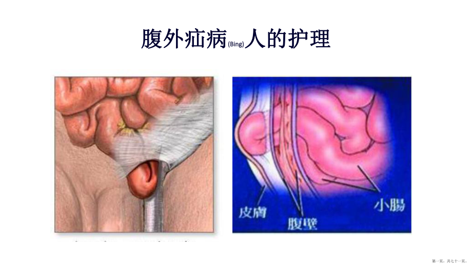 腹外疝病人的護(hù)理及健康宣教ppt_第1頁(yè)