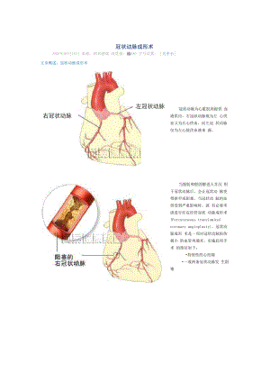 冠状动脉成形术
