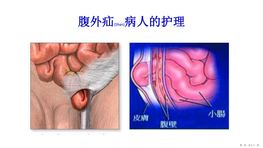 腹外疝病人的護理個案培訓ppt_第1頁