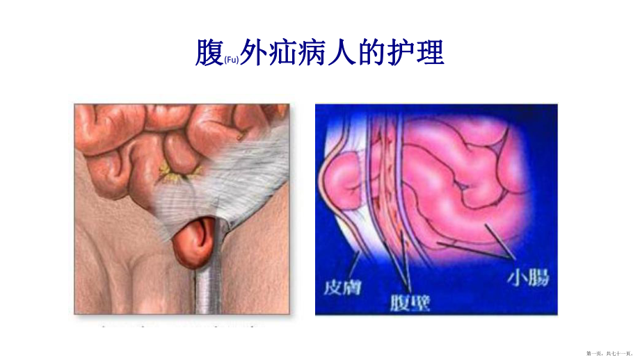 腹外疝病人的護理與病例介紹ppt課件_第1頁