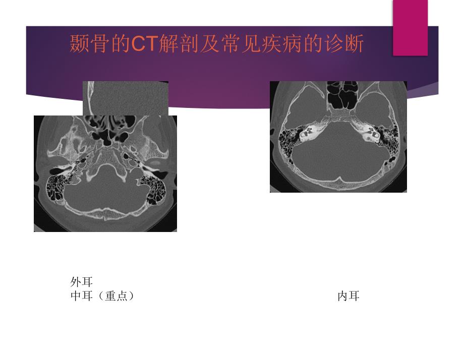 颞骨解剖及中耳炎CT诊断_第1页