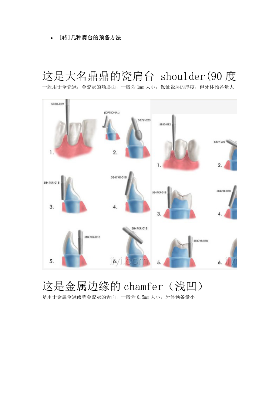 几种肩台的预备方法_第1页